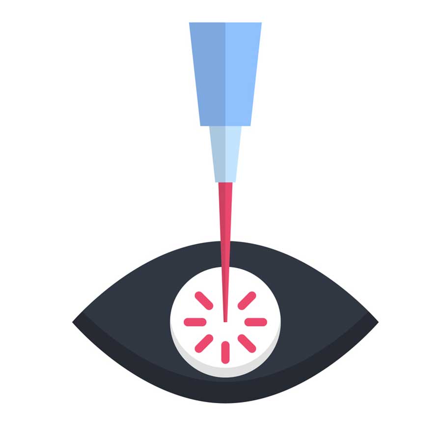 Selective laser trabeculoplasty (SLT)