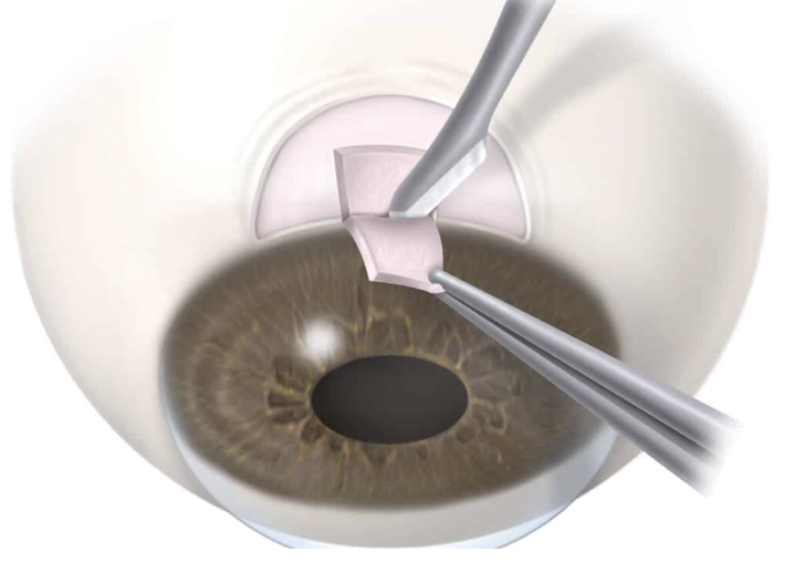 Glaucoma (Filtering) Surgery